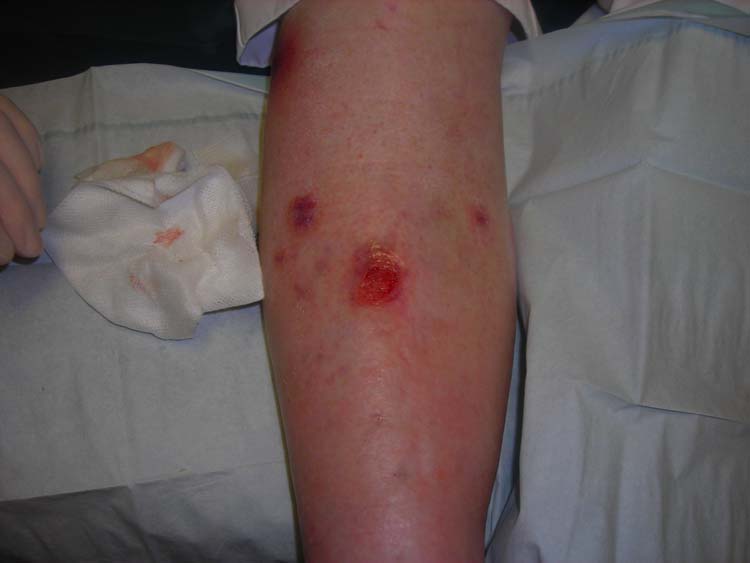 Venous_ulcer_dorsal_leg Venous_ulcer_dorsal_leg