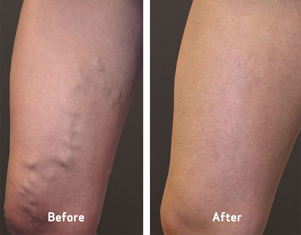 vca-before-and-after-varicose-veins-symptoms-home vca-before-and-after-varicose-veins-symptoms-home